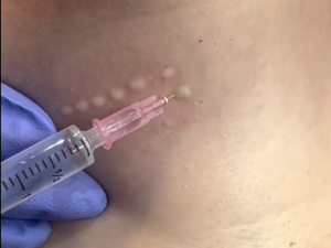 Mesotherapy