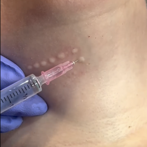 Mesotherapy