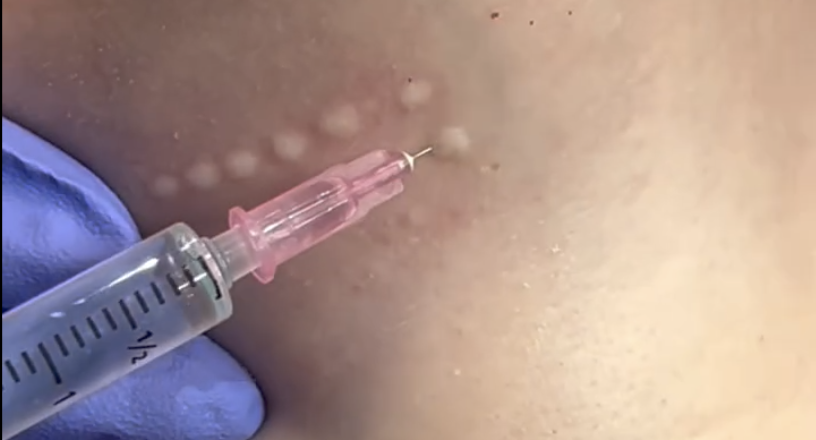Mesotherapy
